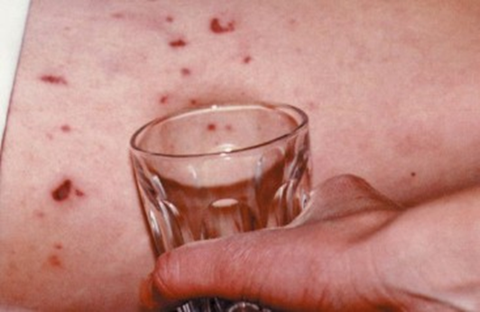 Image of a glass being pressed against skin where there is a rash present.