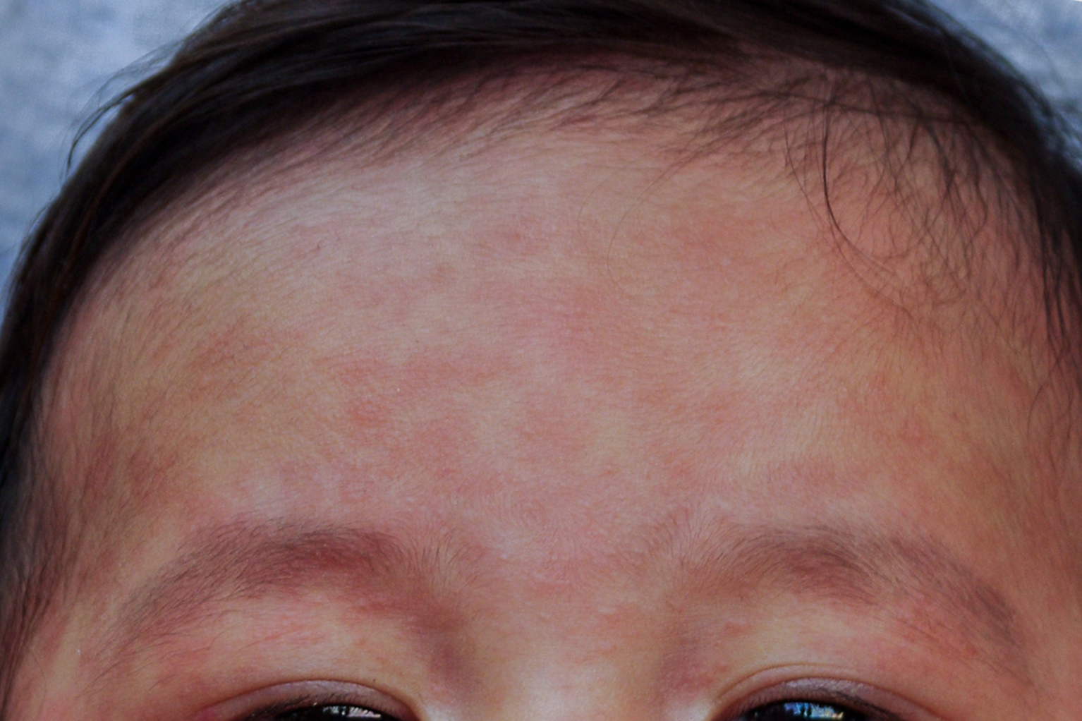 Measles rash on forehead of darker skin