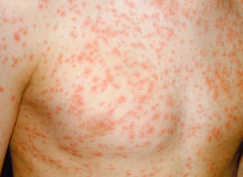 Measles rash on torso