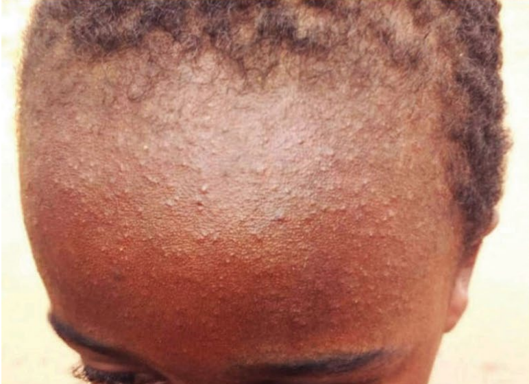 Measles rash on forehead of darker skin
