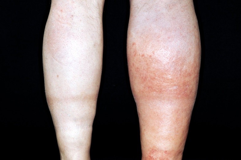 Image of a Deep Vein Thrombosis (DVT) on the back of a leg.