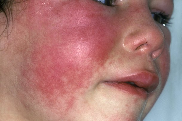 Scarlet Fever