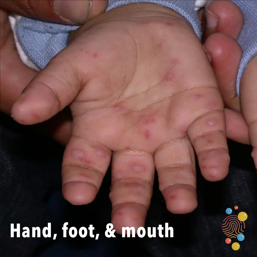 M3-hand-foot-mouth.jpg