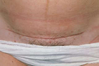 A close up image of a caesarean scar on the lower part of a woman's stomach.