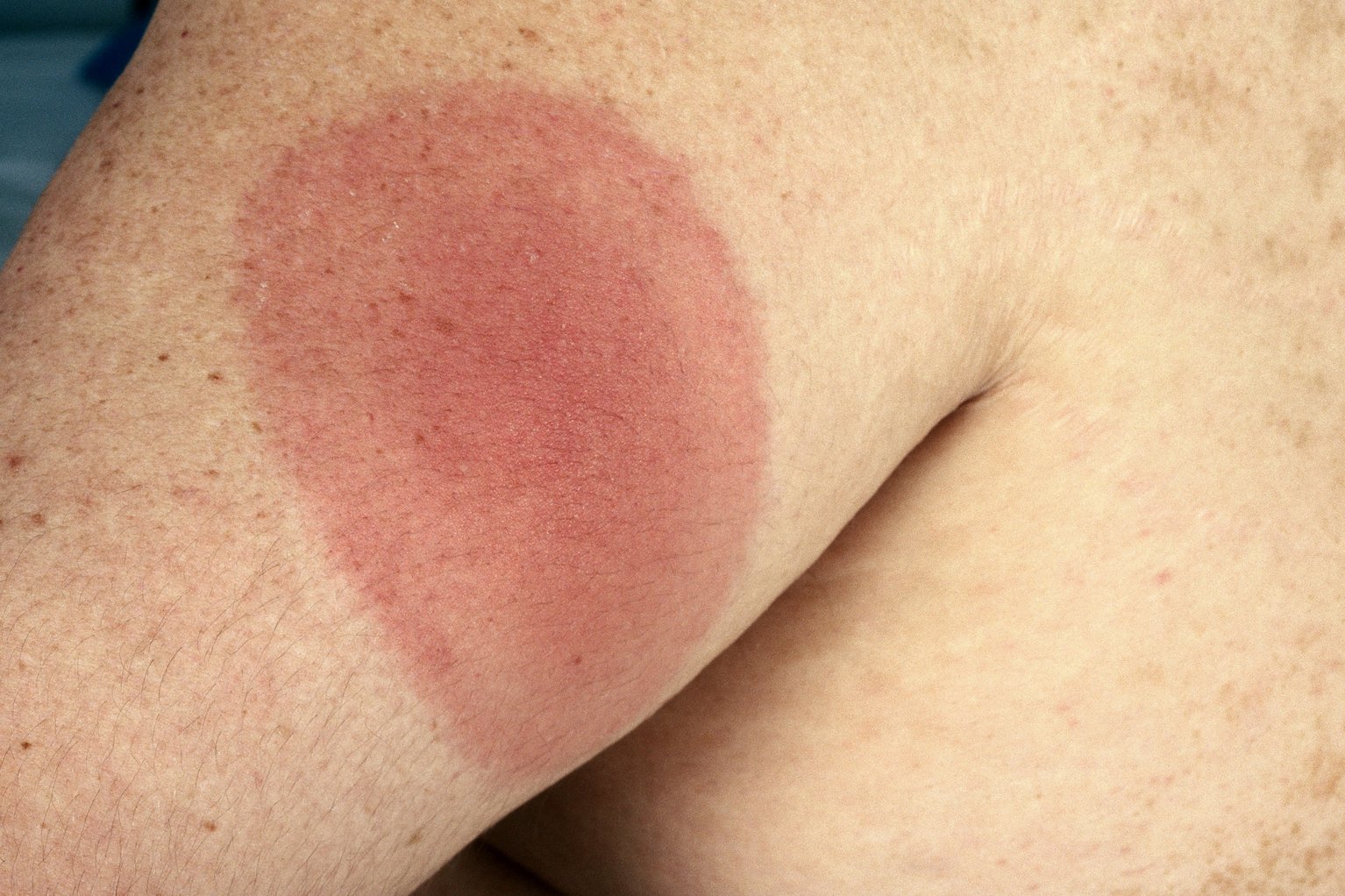 lyme disease picture.jpg