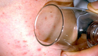 Image of a glass being pressed against a rash to see if it blanches (goes pale)